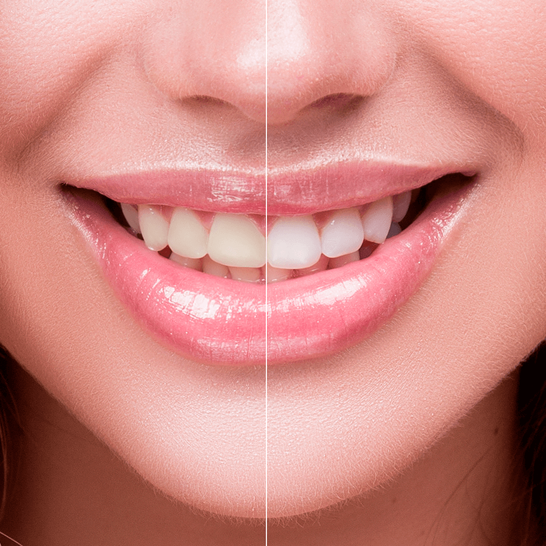 O que é o clareamento dental: tudo sobre o tratamento