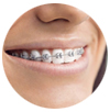 Aparelhos ortodônticos fixos metálicos proporcionam a correção da posição dos dentes com eficiência e resultados excelentes.